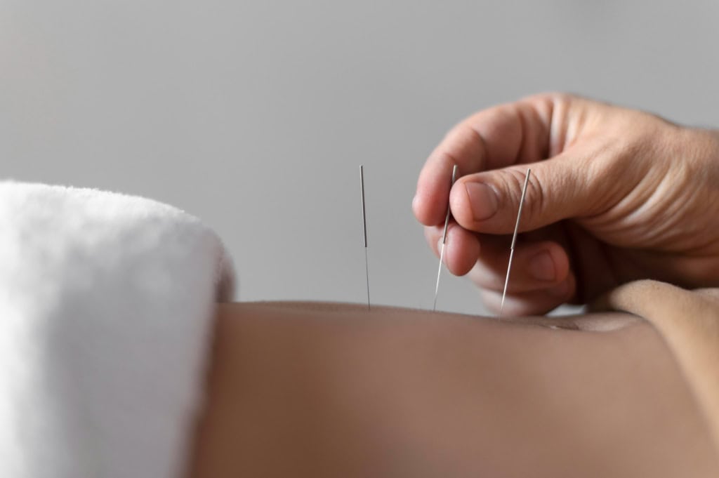 Dry needling